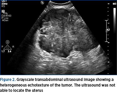 Figure 2. Grayscale transabdominal ultrasound image showing a heterogeneous echotexture of the tumor. The ultrasound was not able to locate the uterus