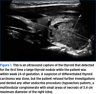Figure 1. This is an ultrasound capture of the thyroid that detected for the first time a large thyroid nodule while the patient was within week 24 of gestation. A suspicion of differentiated thyroid carcinoma was done, but the patient refused further investigations and denied any other endocrine procedure (hypoechoic pattern, a multinodular conglomerate with small areas of necrosis of 3.4 cm maximum diameter of the right lobe)