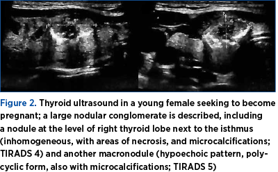 Figure 2. Thyroid ultrasound in a young female seeking to become pregnant; a large nodular conglomerate is described, including a nodule at the level of right thyroid lobe next to the isthmus (inhomogeneous, with areas of necrosis, and microcalcifications; TIRADS 4) and another macronodule (hypoechoic pattern, polycyclic form, also with microcalcifications; TIRADS 5)