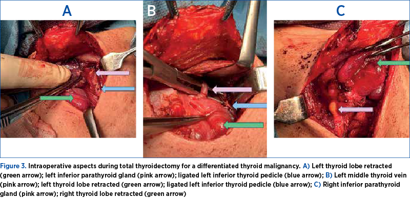 Figure 3. Intraoperative aspects during total thyroidectomy for a differentiated thyroid malignancy. A) Left thyroid lobe retracted (green arrow); left inferior parathyroid gland (pink arrow); ligated left inferior thyroid pedicle (blue arrow); B) Left middle thyroid vein (pink arrow); left thyroid lobe retracted (green arrow); ligated left inferior thyroid pedicle (blue arrow); C) Right inferior parathyroid gland (pink arrow); right thyroid lobe retracted (green arrow)