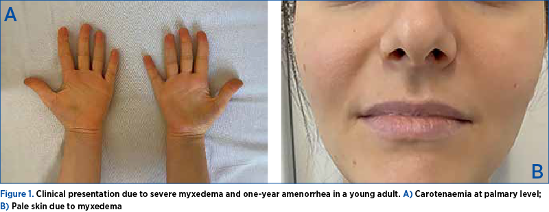 Figure 1. Clinical presentation due to severe myxedema and one-year amenorrhea in a young adult. A) Carotenaemia at palmary level;  B) Pale skin due to myxedema