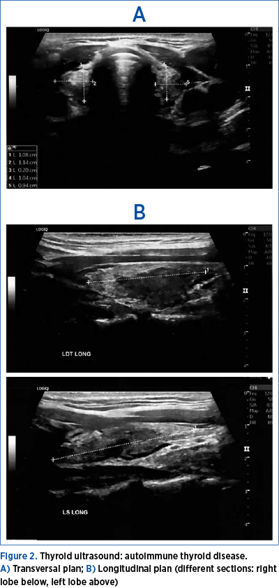 Figure 2. Thyroid ultrasound: autoimmune thyroid disease.  A) Transversal plan; B) Longitudinal plan (different sections: right lobe below, left lobe above)