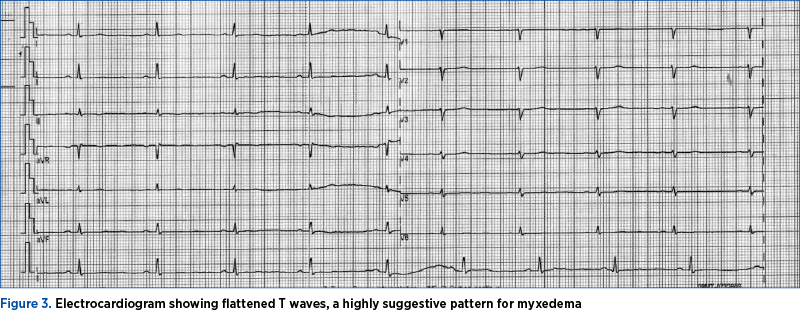Figure 3. Electrocardiogram showing flattened T waves, a highly suggestive pattern for myxedema