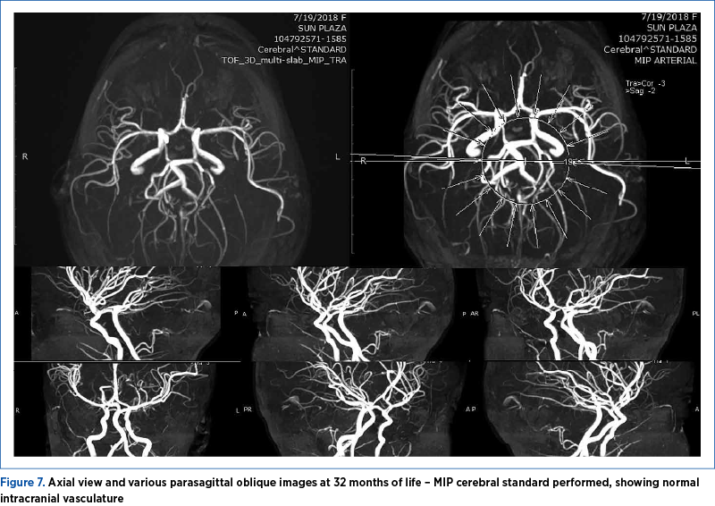 Figure 7. Axial view and various parasagittal oblique images at 32 months of life – MIP cerebral standard performed, showing normal intracranial vasculature