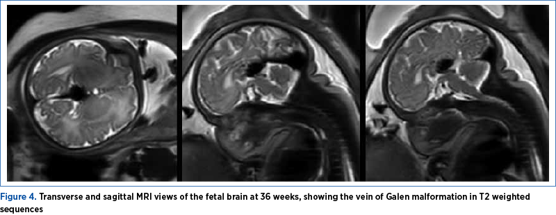 Figure 4. Transverse and sagittal MRI views of the fetal brain at 36 weeks, showing the vein of Galen malformation in T2 weighted sequences