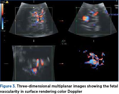 Figure 3. Three-dimensional multiplanar images showing the fetal vascularity in surface rendering color Doppler