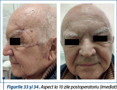 Figurile 33 şi 34. Aspect la 10 zile postoperatoriu (imediat)