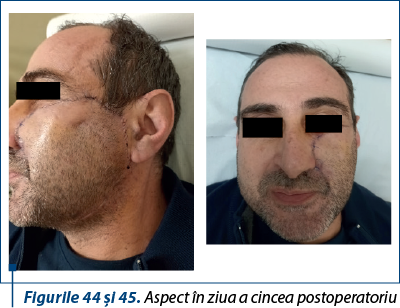 Figurile 44 şi 45. Aspect în ziua a cincea postoperatoriu