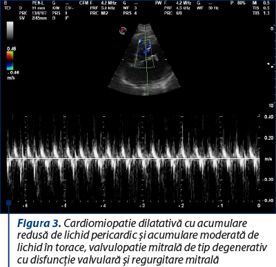 Figura 3. Cardiomiopatie dilatativă cu acumulare redusă de lichid pericardic şi acumulare moderată de lichid în torace, valvulopatie mitrală de tip degenerativ cu disfuncţie valvulară şi regurgitare mitrală