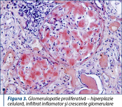 Figura 3. Glomerulopatie proliferativă – hiperplazie celulară, infiltrat inflamator şi crescente glomerulare