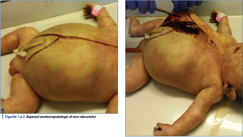 Figurile 1 şi 2. Aspectul anatomopatologic al nou-născutului