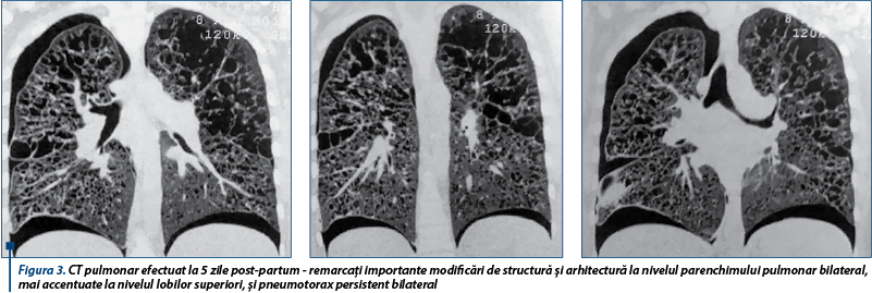 Figura 3. CT pulmonar efectuat la 5 zile post-partum - remarcaţi importante modificări de structură şi arhitectură la nivelul parenchimului pulmonar bilateral, mai accentuate la nivelul lobilor superiori, şi pneumotorax persistent bilateral 