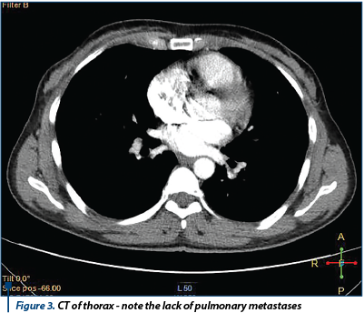 Figure 3. CT of thorax - note the lack of pulmonary metastases