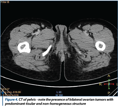Figure 4. CT of pelvis - note the presence of bilateral ovarian tumors with predominant tisular and 