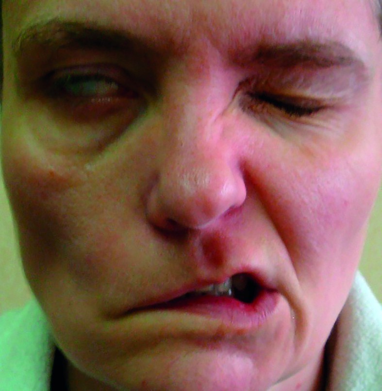 Figura 1. Paralizia nervului facial UD