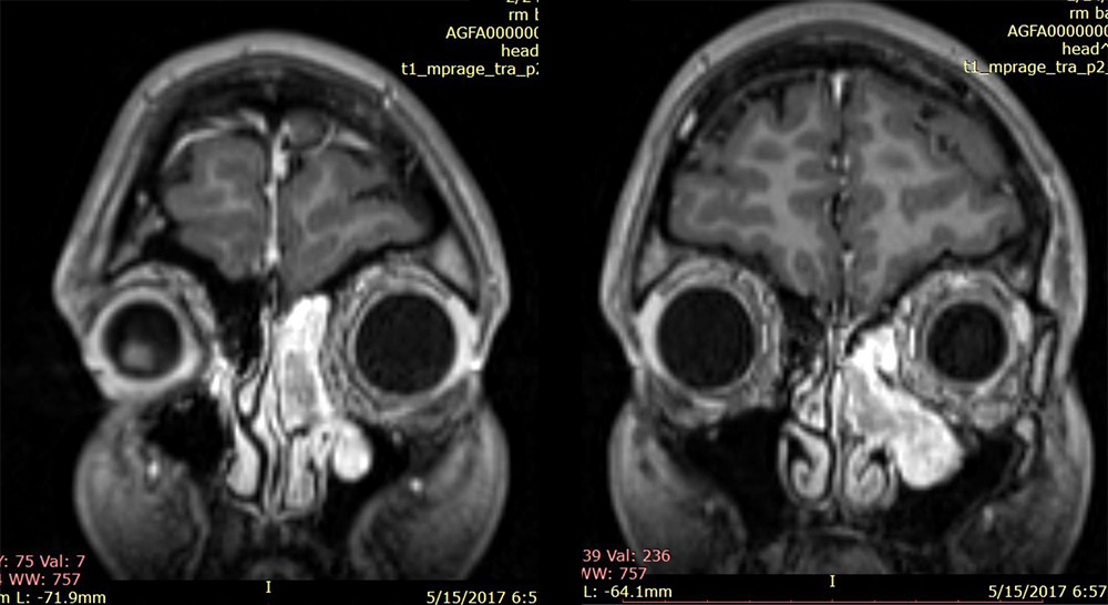 Figura 2. Examen RMN craniocerebral cu substanță de contrast efectuat preoperatoriu