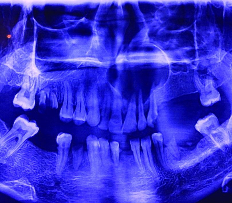 Figura 2-1. Chist maxilar stâng ce depășește linia mediană cu extensie în sinusul maxilar şi fosele nazale – RX panoramic