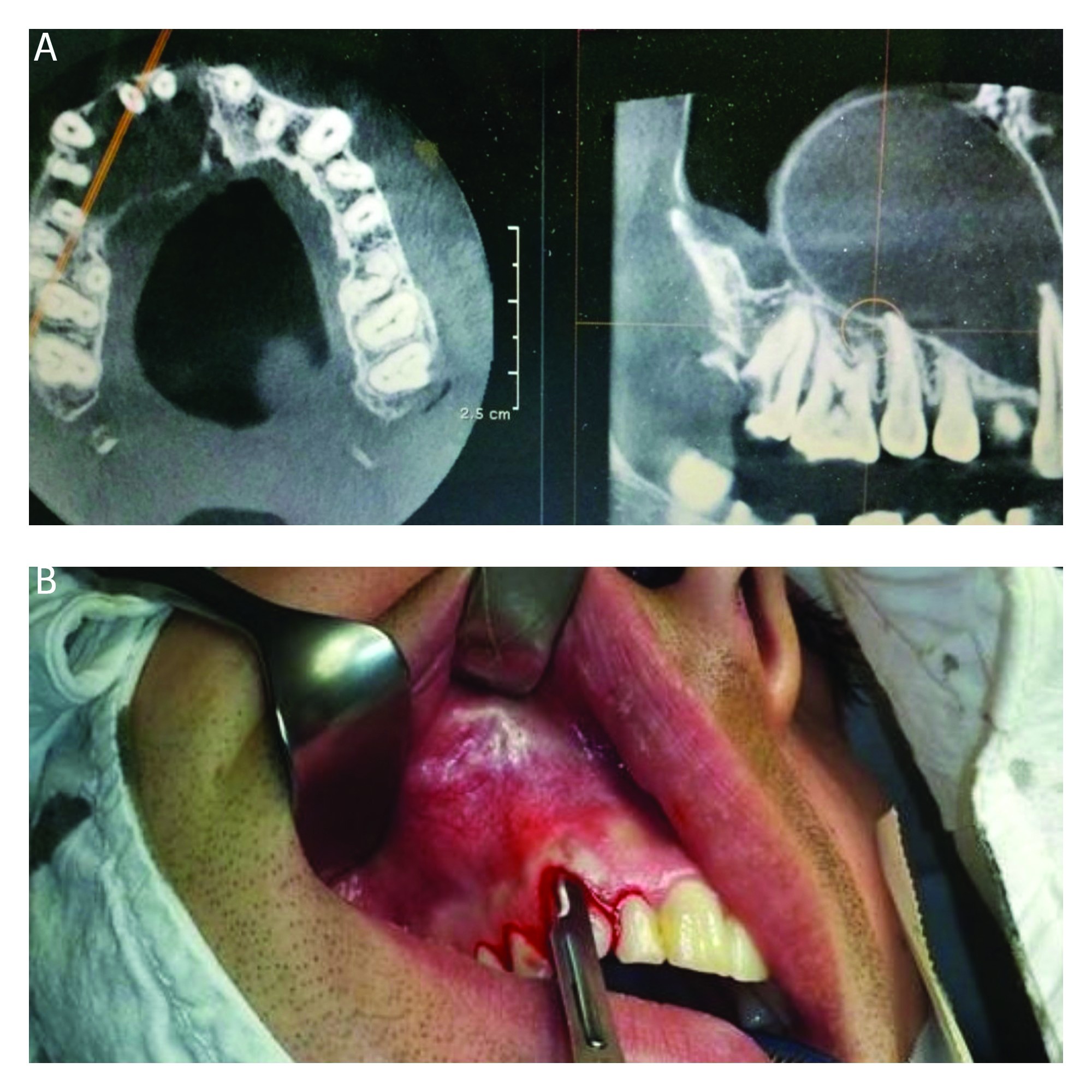 Figura 3-1. A. Chist maxilar drept cu extensie în sinusul maxilar – secţiuni CT; B. Imagine intraoperatorie cu corticala deformată de formaţiunea chistică