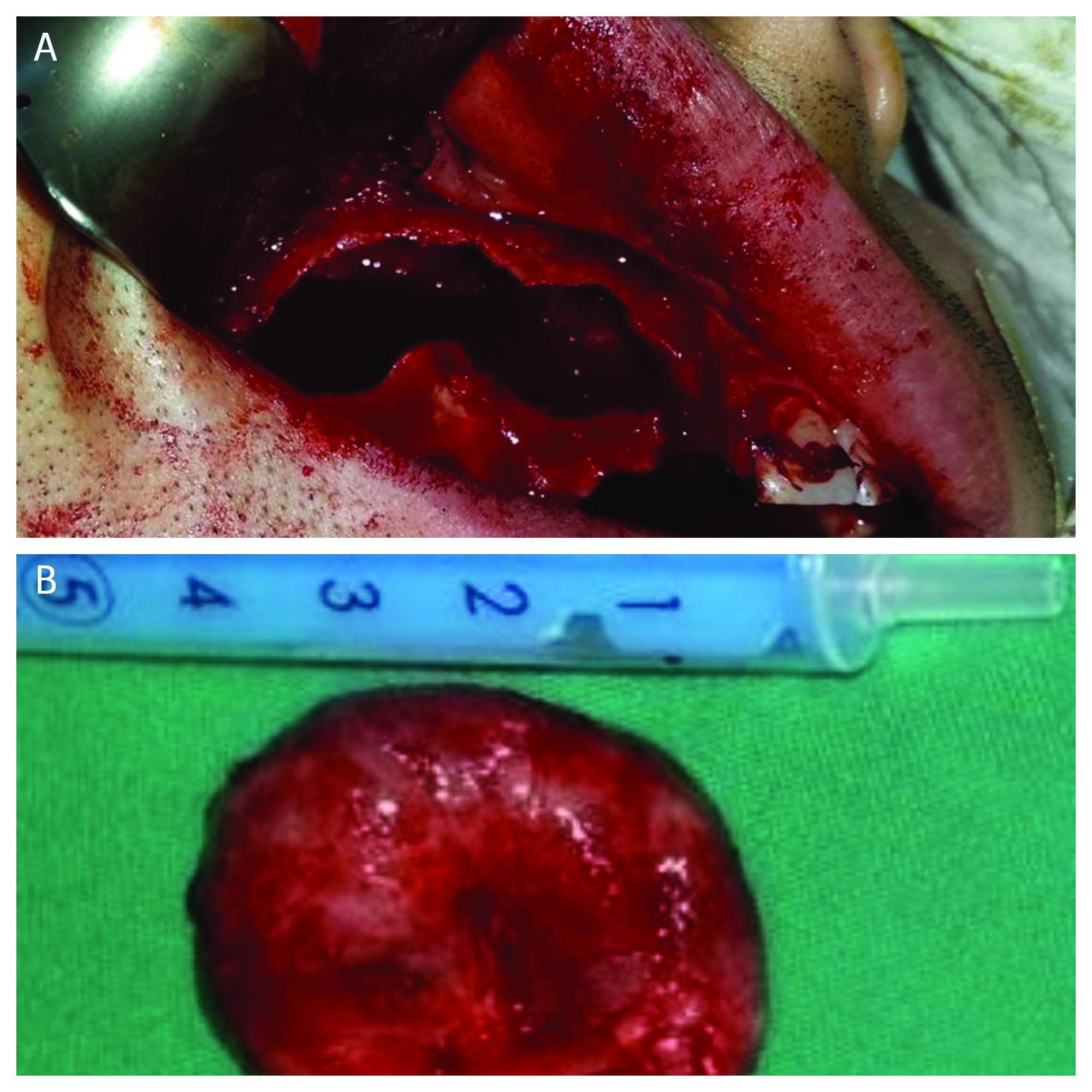 Figura 3-2. A. Aspect intraoperator al defectului după chistectomie; B. Piesa excizată