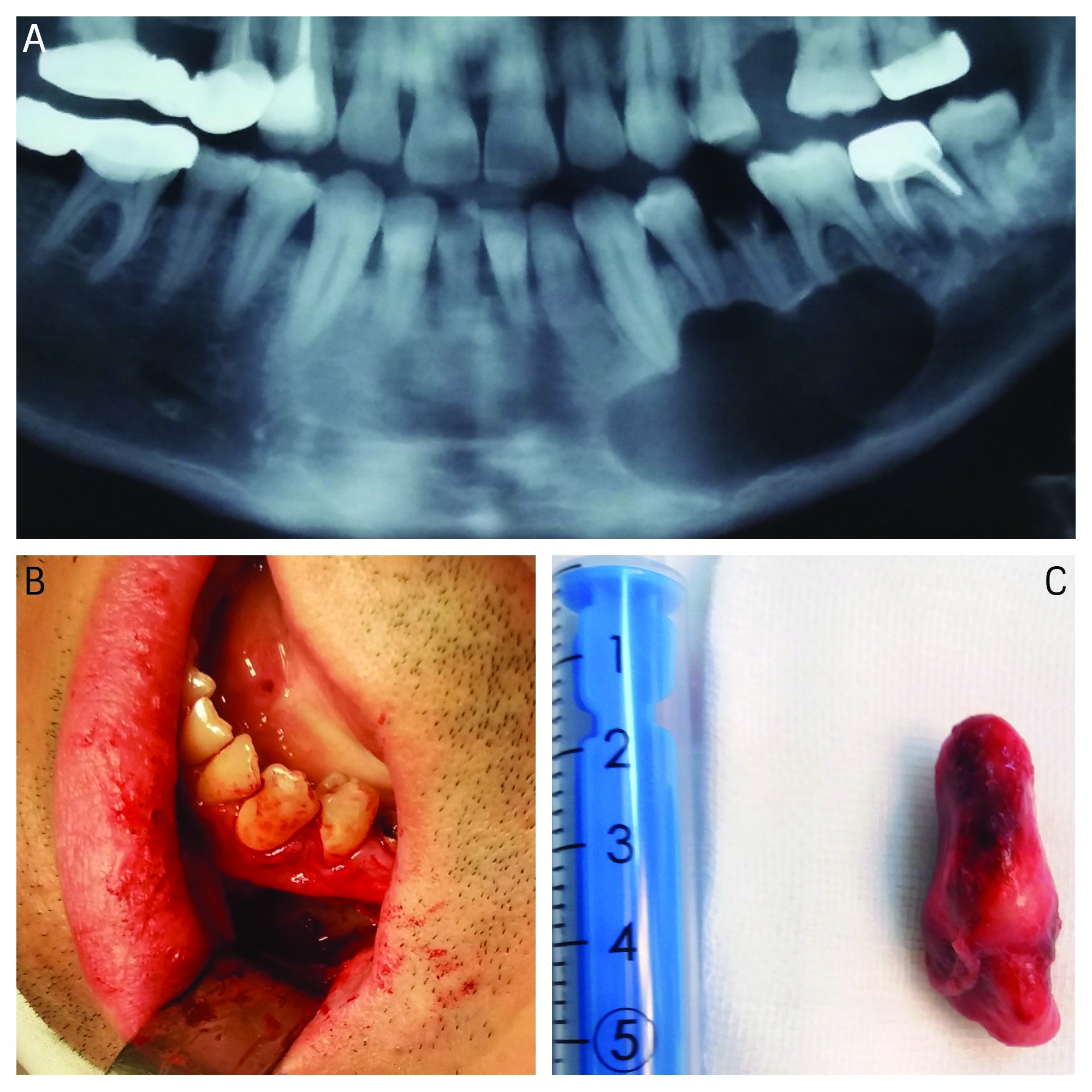 Figura 4. A. Chist mandibular stâng ce şterge conturul canalului mandibular; B. Aspect intraoperator al defectului după chistectomie; C. Piesa excizată