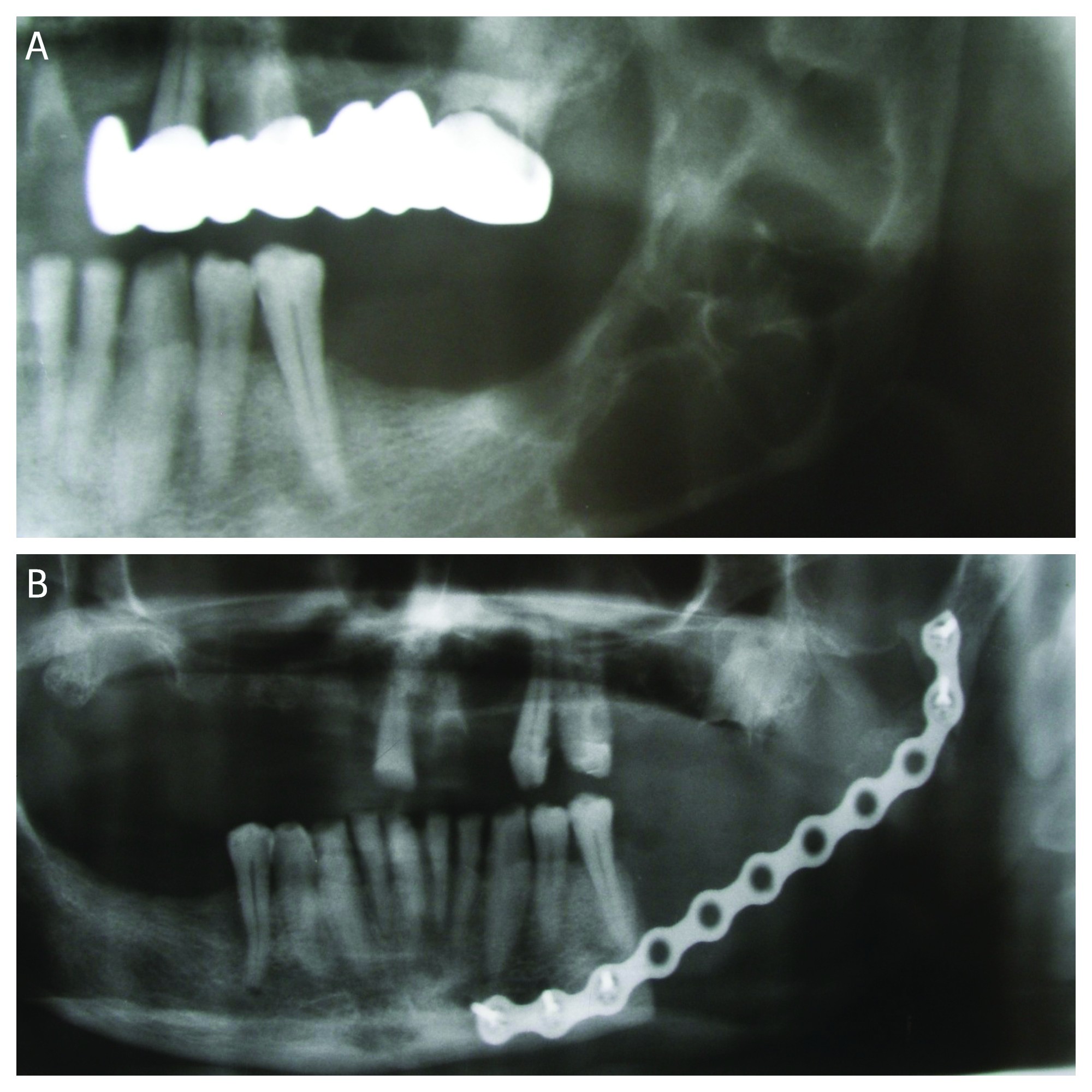 Figura 5-2. A. Chist mandibular stâng ce cuprinde gonionul şi ramul mandibular – RX panoramică;  B. RX panoramic post-rezecție segmentară şi reconstrucţie defect cu placă primară de osteosinteză