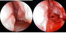 Figura 5. Aspect pre- și postoperatoriu cornetul inferior stâng