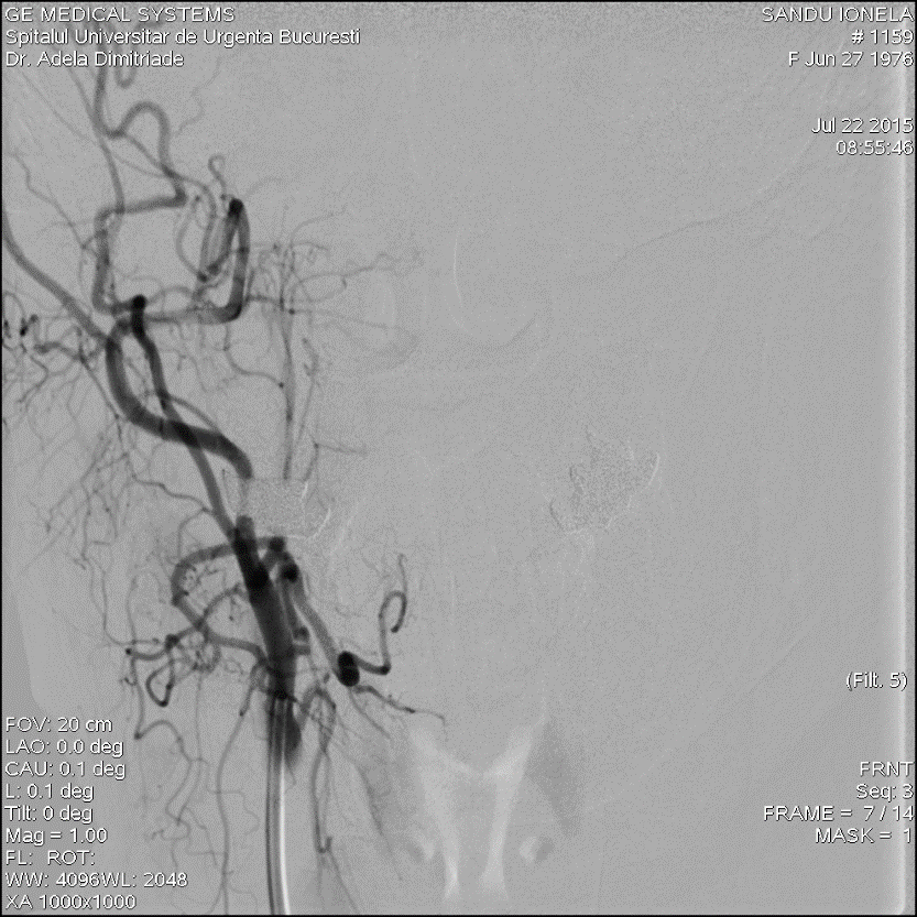 Figura 3. Angiografie carotidiană bilaterală cu embolizare de arteră linguală dreaptă