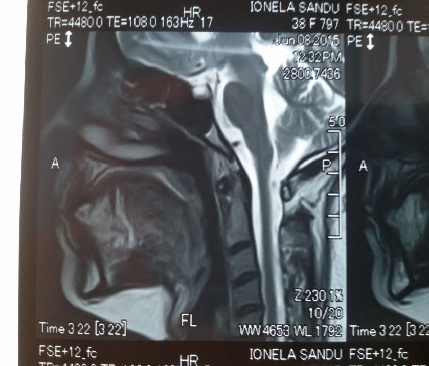 Figura 2. IRM cervical cu contrast i.v. – încărcare patologică pelvilinguală