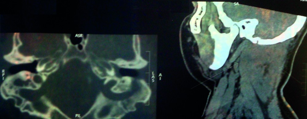 Figura 4. Focare osteitice în regiunea antrală, celulele apicale și perisinuzale, infiltrat cervical posterior de mușchiul sternocleidomastoidian
