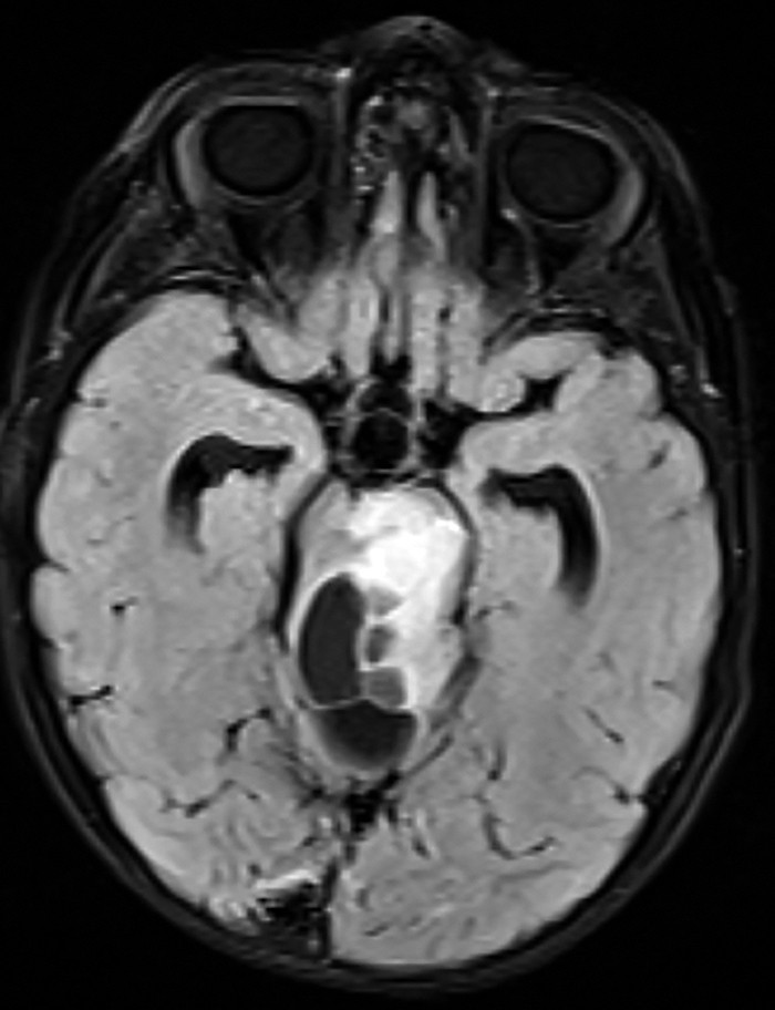 Figura 2. IRM cerebral secvență T1 ponderată, secțiune transversală, formațiune tumorală la nivelul trunchiului cerebral (imagine din arhiva secției de Neurologie Pediatrică a Spitalului de Copii „Dr. Victor Gomoiu” București) 