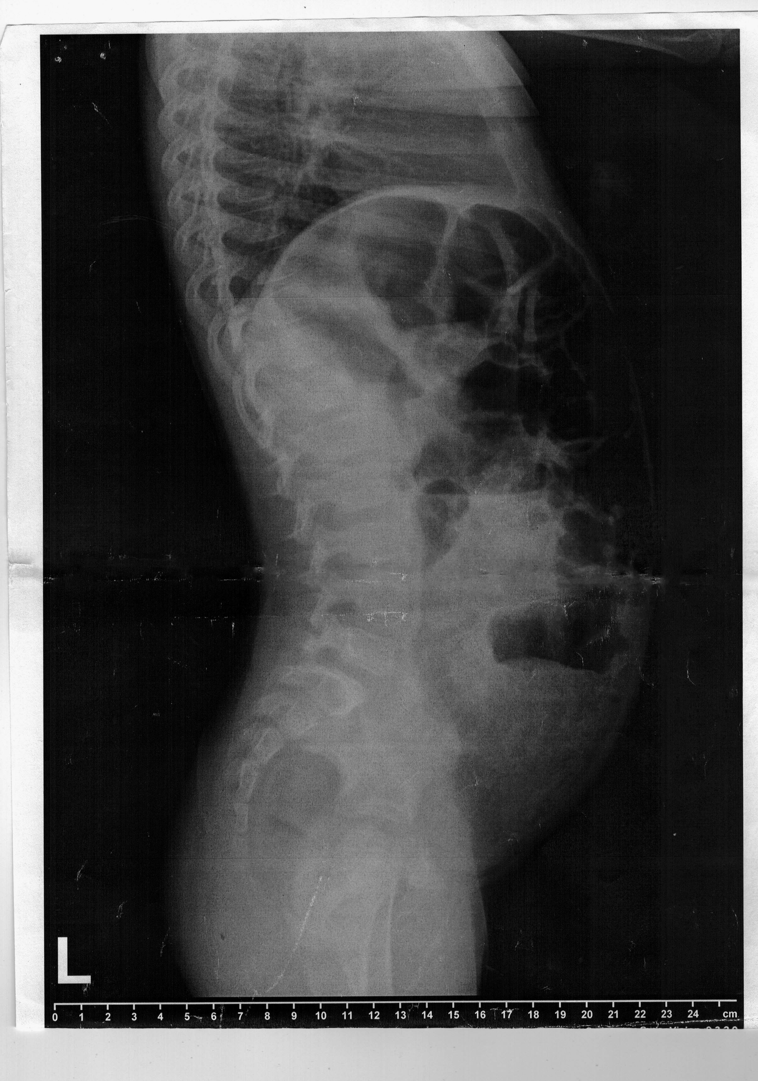 Figura 2. Radiografie abdominală pe gol