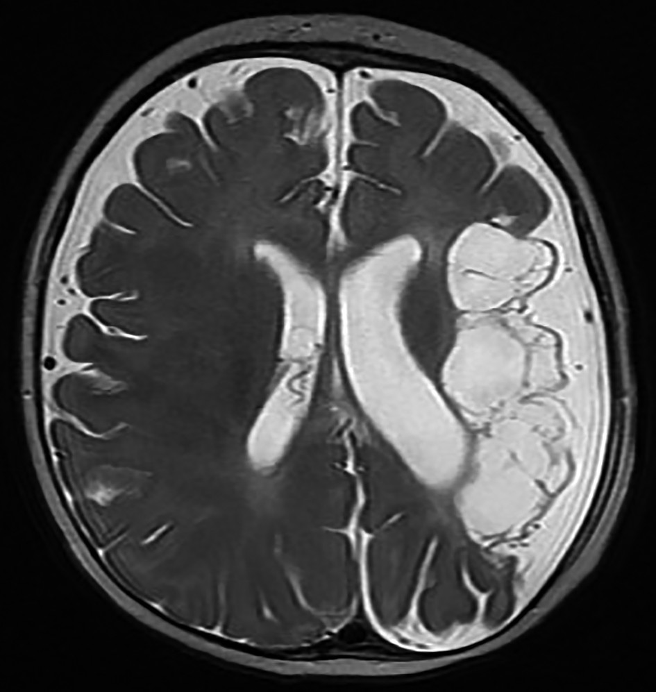 Figura 2. D.I. - IRM cerebral secvența T2