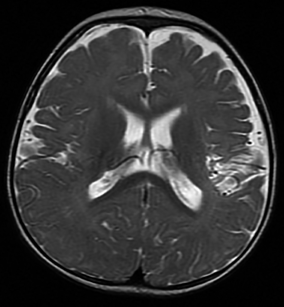Figura 4. D.P. - IRM cerebral secvența T2