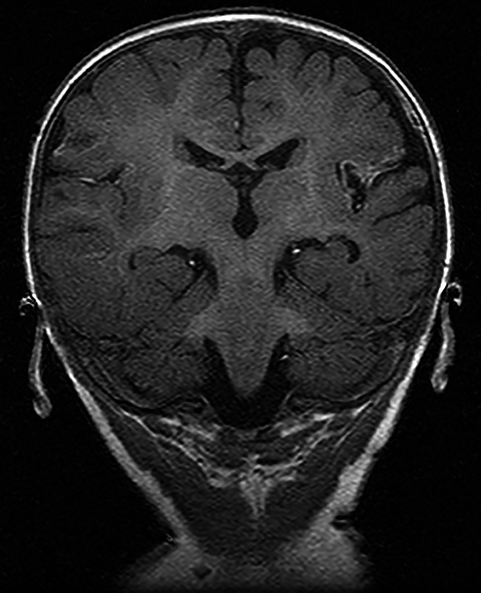 Figura 3. D.P. - IRM cerebral secvența T1