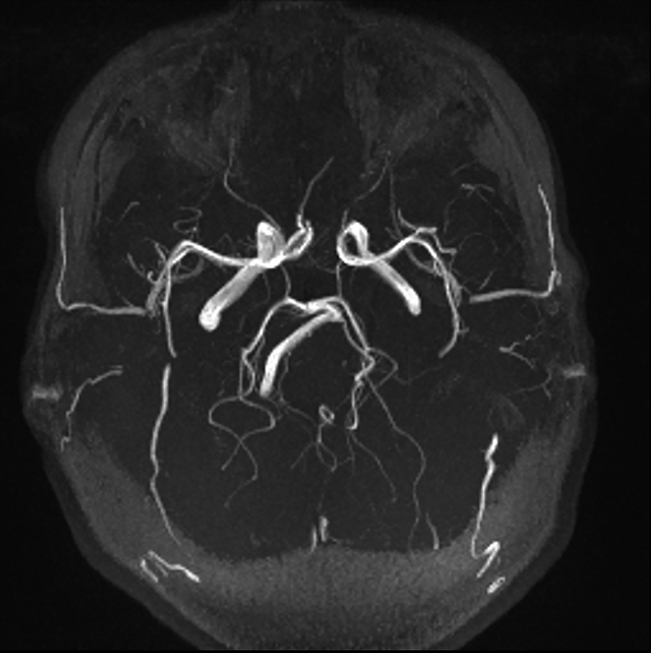 Figura 6. M.N. - IRM cerebral secvența angiografică