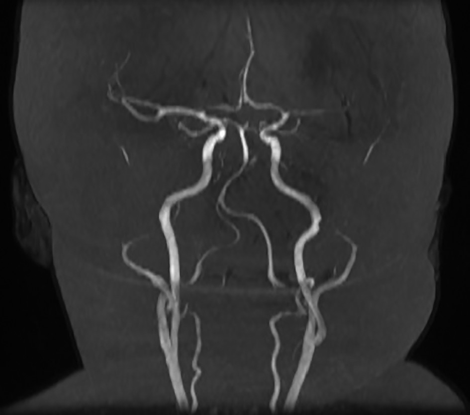 Figura 1. D.I. - IRM cerebral, secvență angiografică