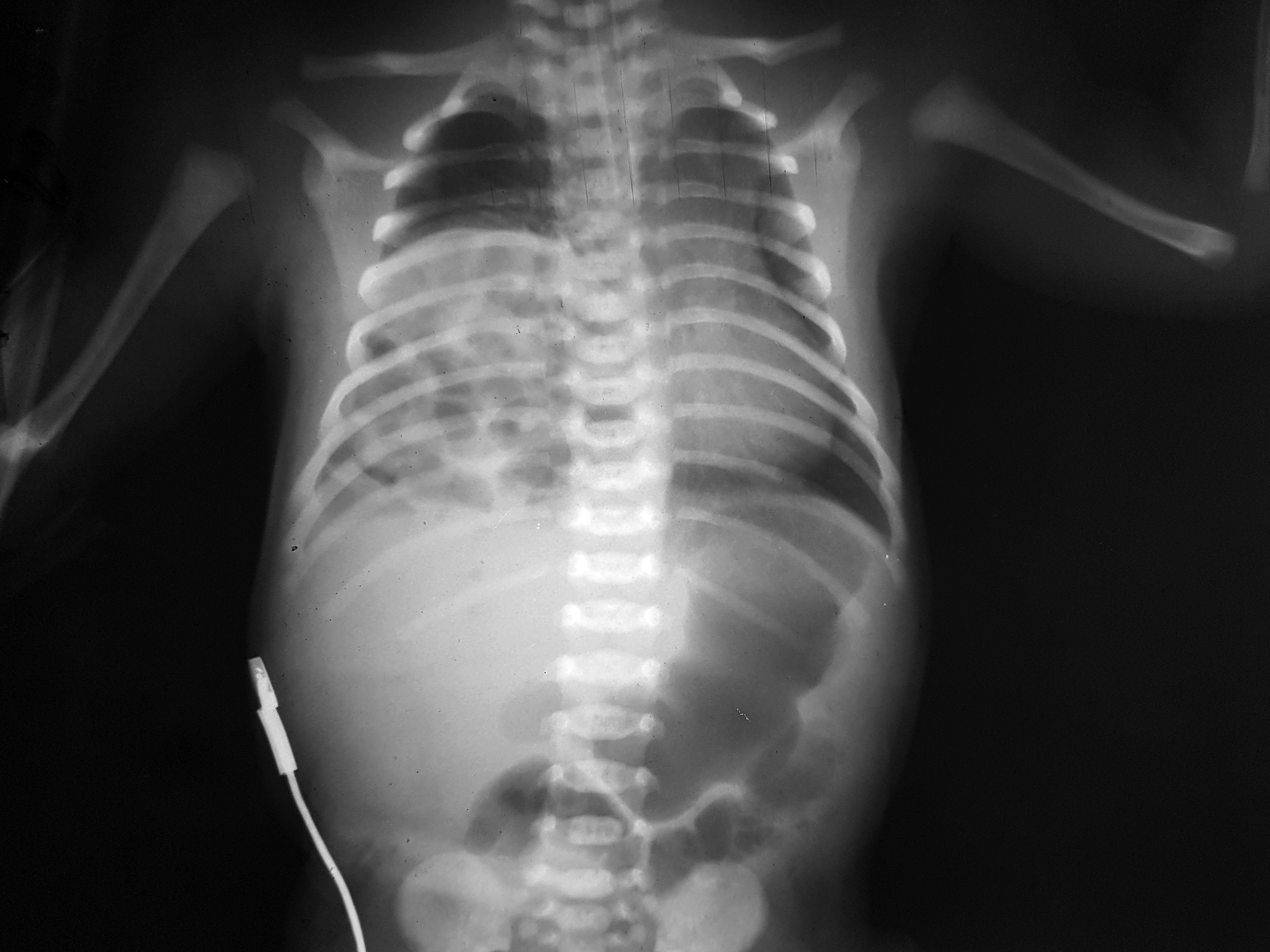 Figure 1A. Chest radiograph showing the cyst-like aspect in the right hemithorax, suggestive for bowel loops