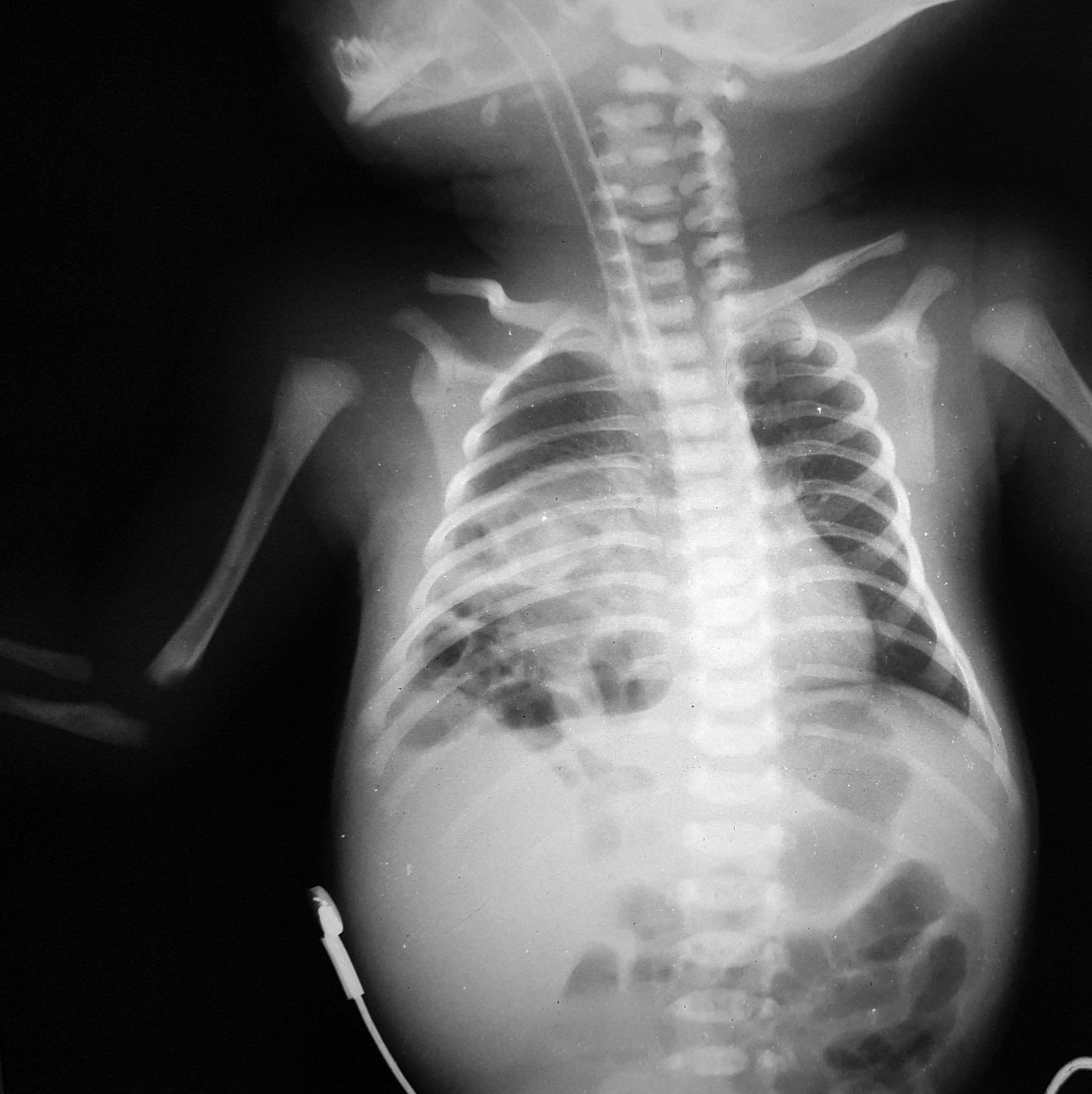 Figure 1B. Chest radiograph. The mediastinum is slightly shifted to the left. Few loops of intestine can be seen in the abdomen