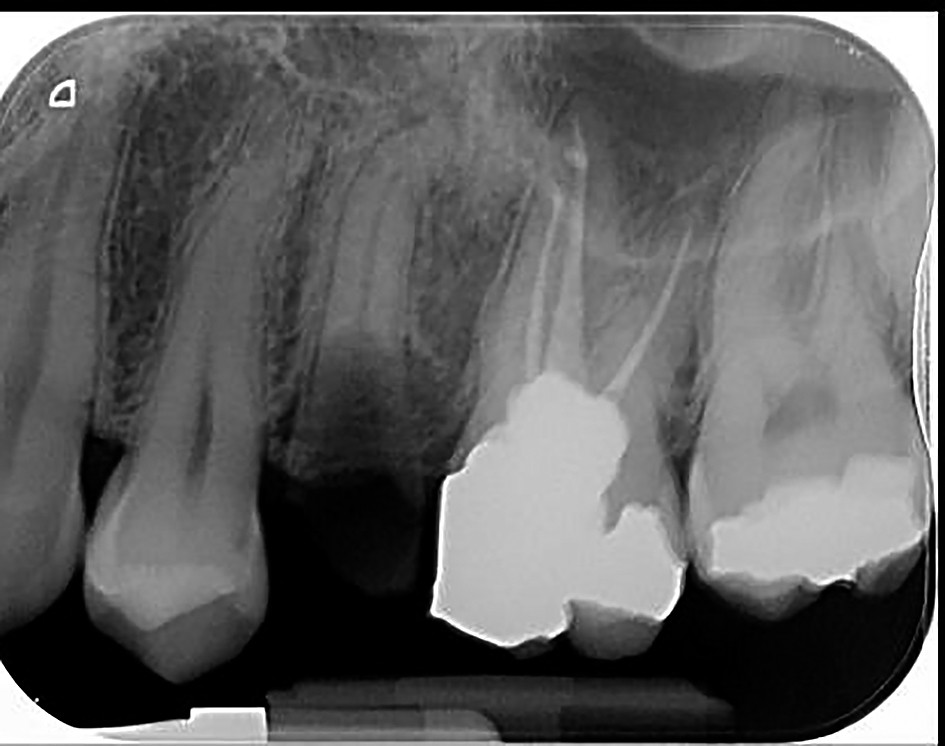 Figure 3. Chronic apical periodontitis 25 which can be endodontically treated
