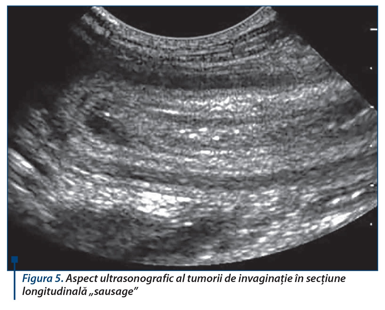 Figura 5. Aspect ultrasonografic al tumorii de invaginație în secțiune longitudinală „sausage”