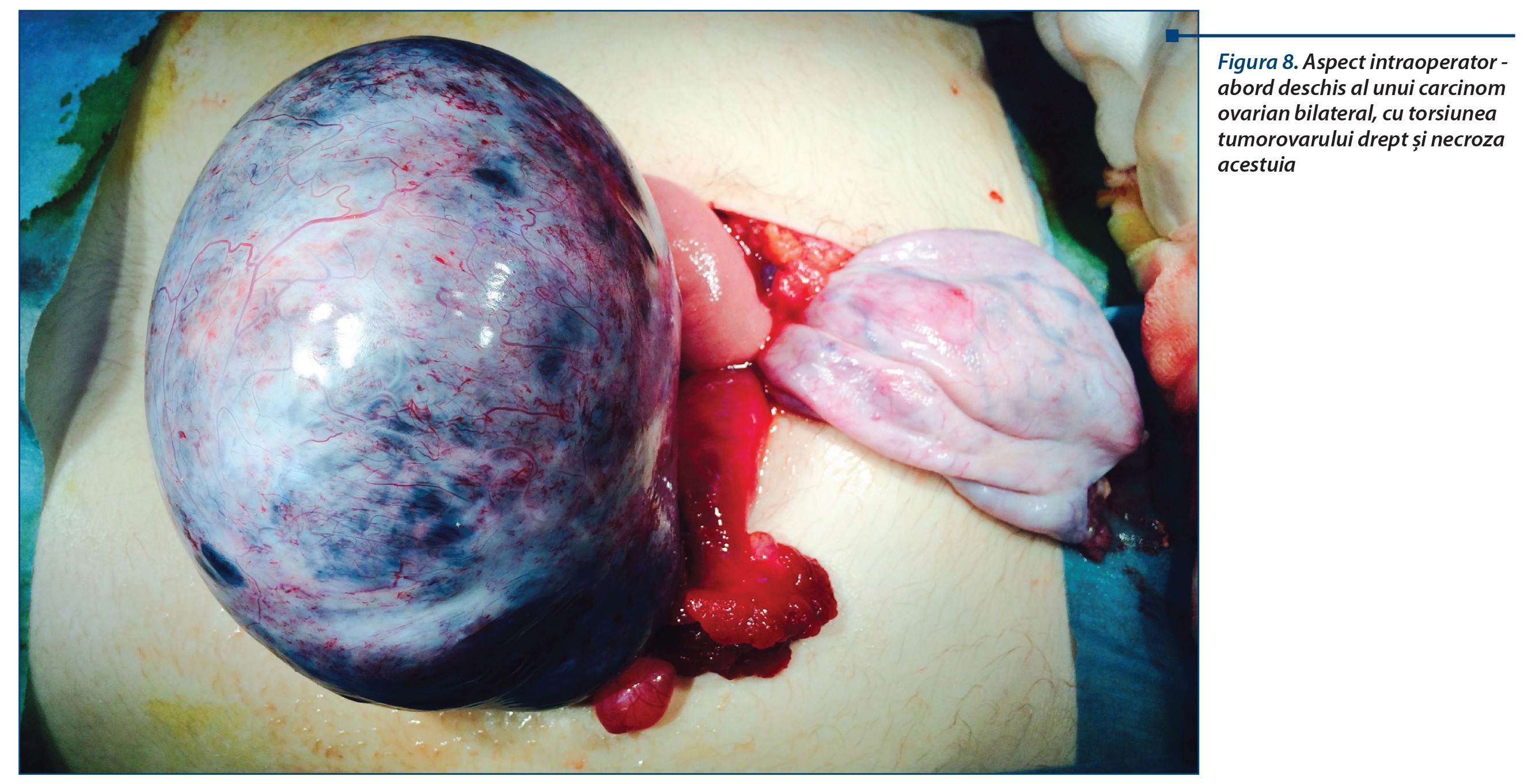 Figura 8. Aspect intraoperator - abord deschis al unui carcinom ovarian bilateral, cu torsiunea tumorovarului drept și necroza acestuia