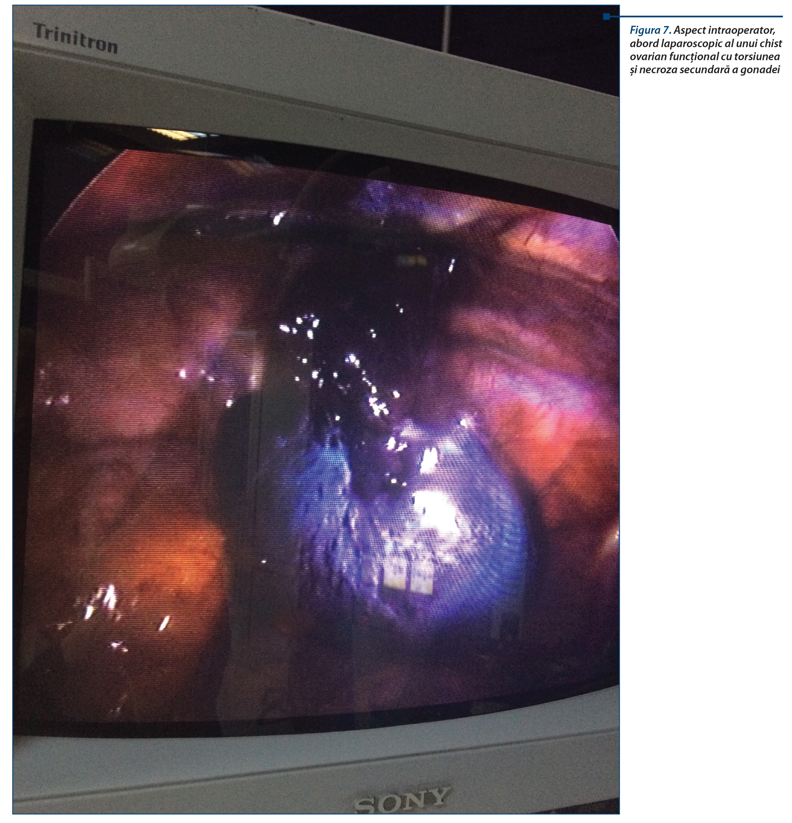 Figura 7. Aspect intraoperator, abord laparoscopic al unui chist ovarian funcțional cu torsiunea și necroza secundară a gonadei