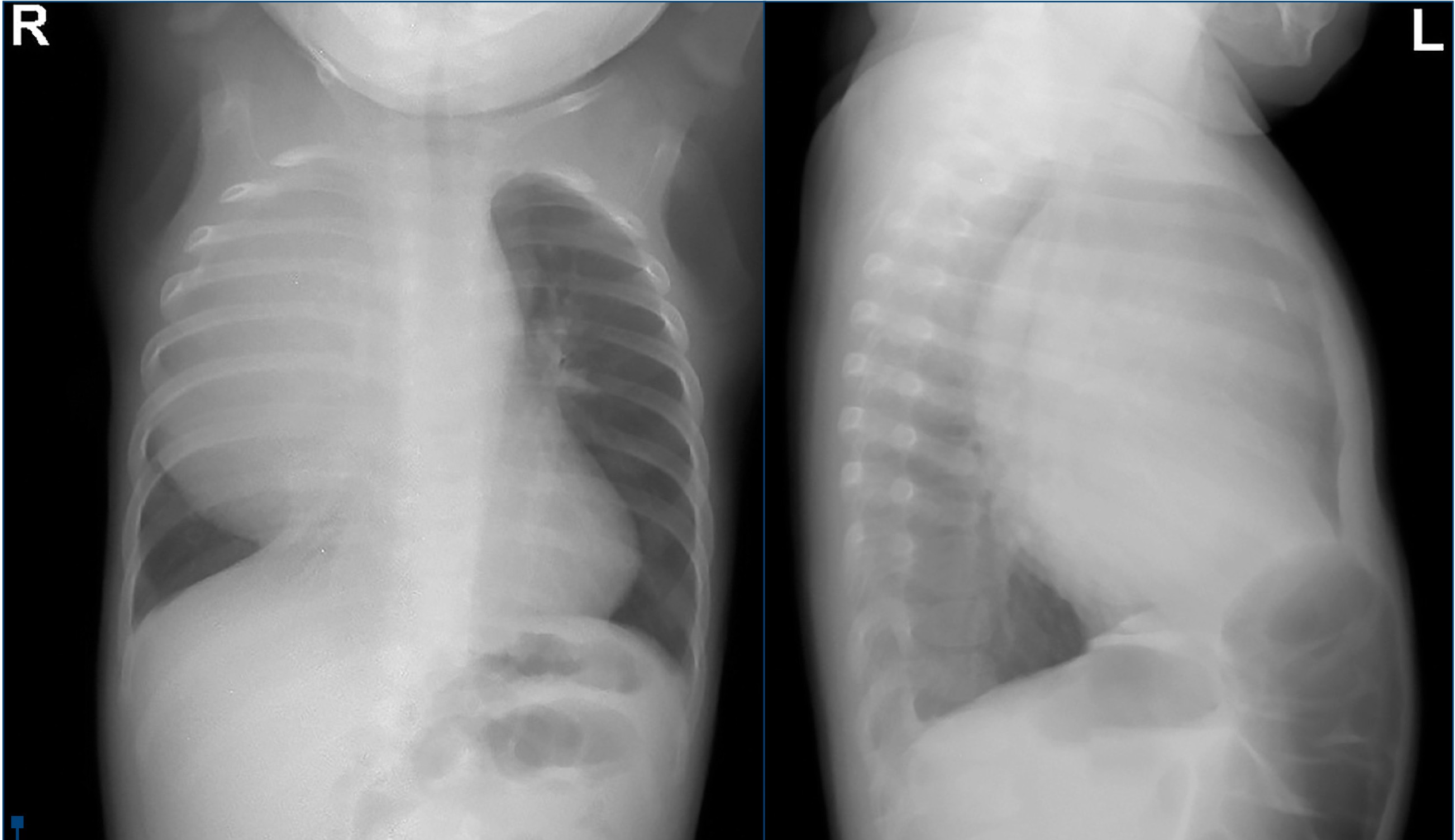 Figura 1. Radiografie toracică postero-anterioară și radiografie de profil drept 