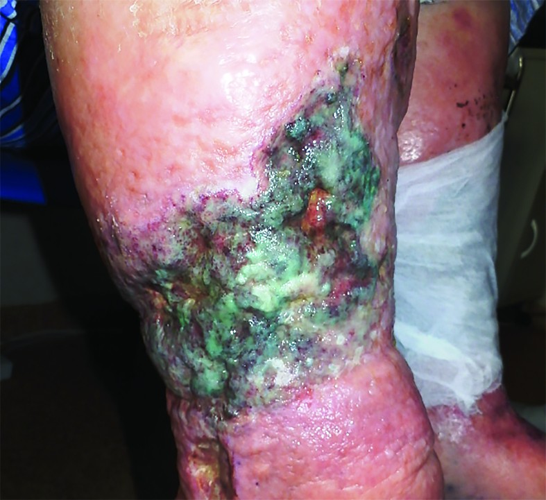 Figura 1. Ulcerație de mari dimensiuni, cu depozit fibrinos și exsudat pe suprafață de culoare albastru-verzui