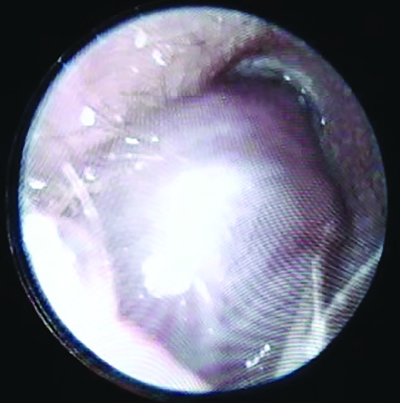 Figura 1. Endoscopie otică - formațiune voluminoasă, obturantă a CAE al urechii stângi