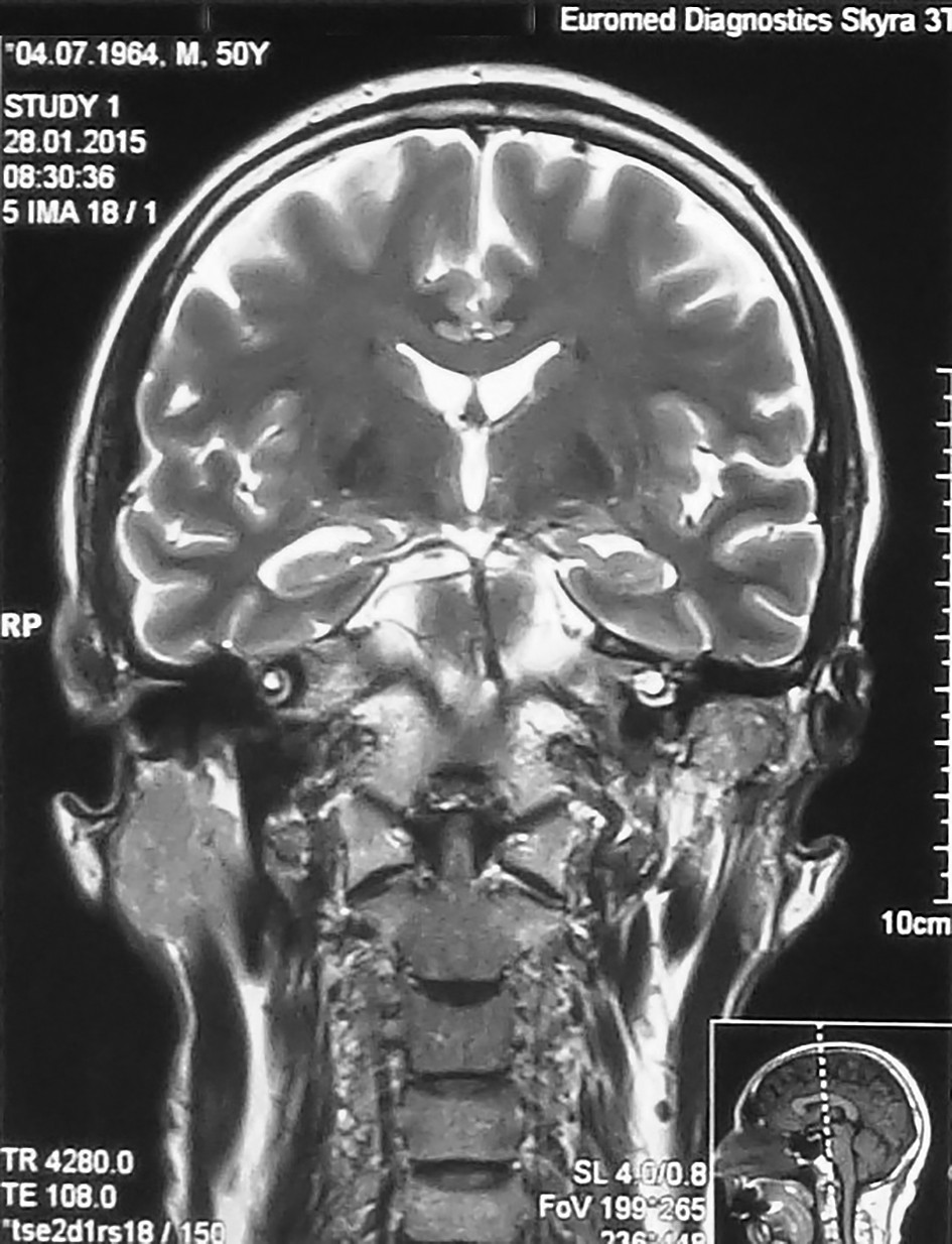 Figura 2. Examen CT - formațiune voluminoasă la nivelul conductului auditiv extern al urechii stângi, de origine vasculară (conform valorilor densimetrice)