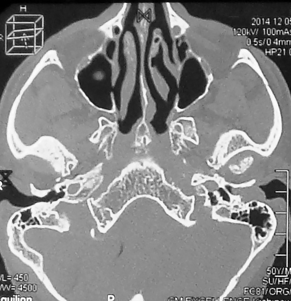 Figura 3. Examen RM - formațiune voluminoasă, cu obturarea conductului auditiv extern al urechii stângi, gadolinofilă