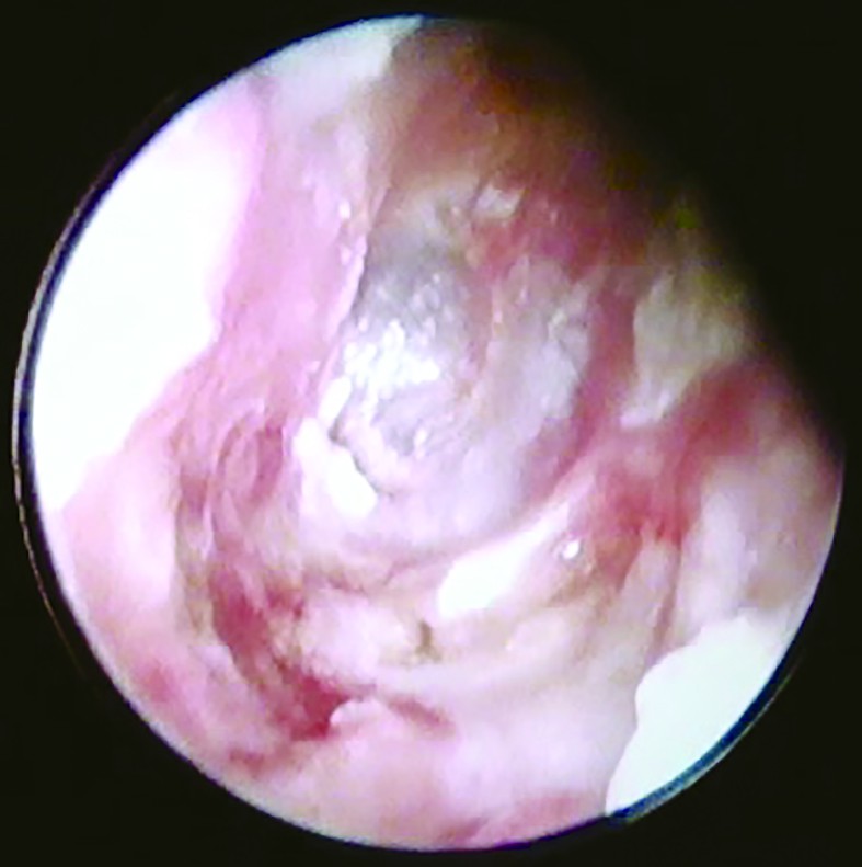 Figura 5. Endoscopie otică - aspect postoperator (la o lună)