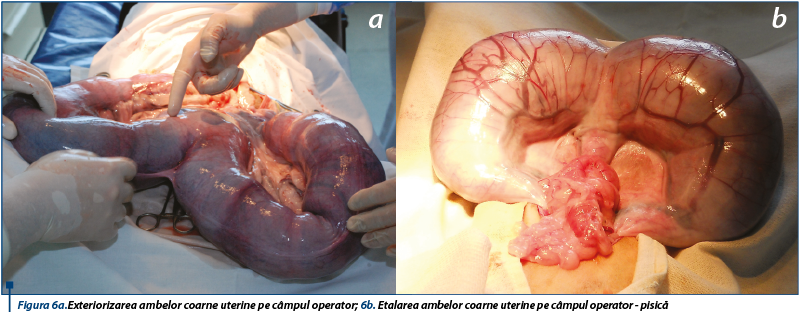 Figura 6a.Exteriorizarea ambelor coarne uterine pe câmpul operator; 6b. Etalarea ambelor coarne uter