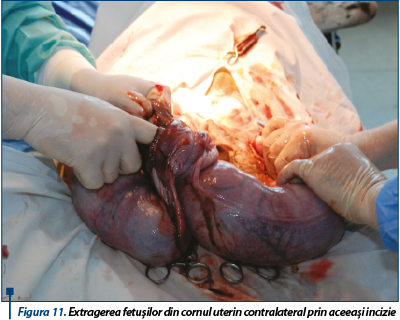 Figura 11. Extragerea fetușilor din cornul uterin contralateral prin aceeași incizie